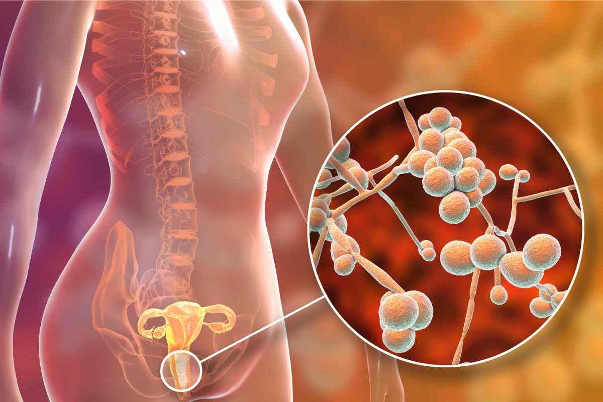 candidiasis salud mujer consejos zona íntima