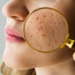 causas brote de acné