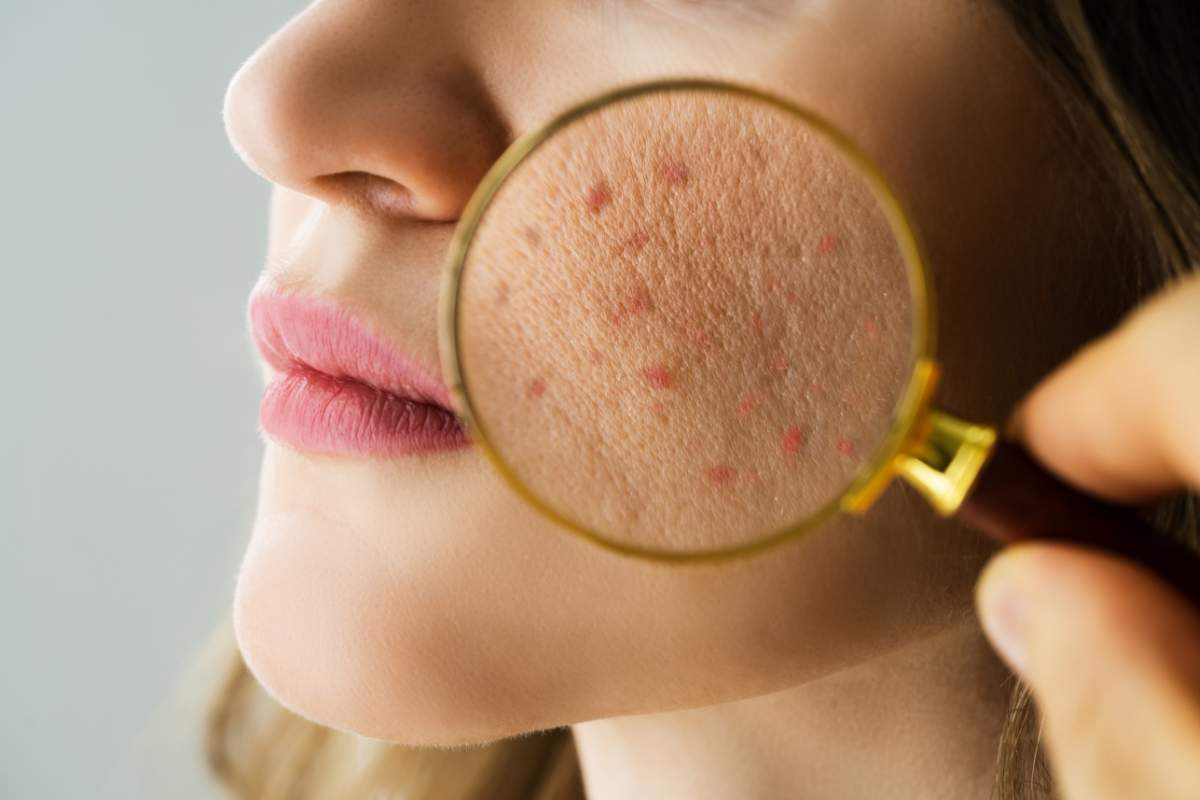 causas brote de acné 